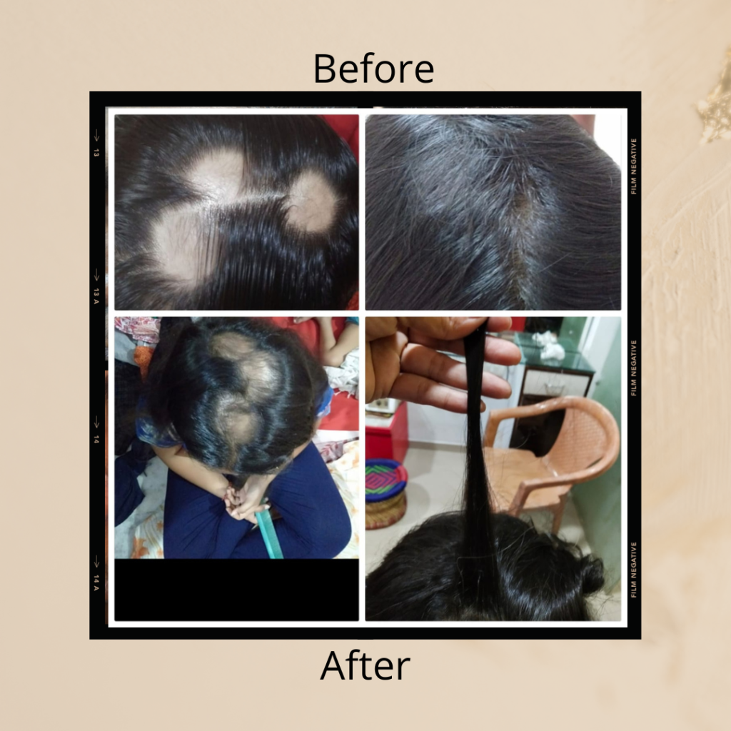 Alopecia Treatment Surat